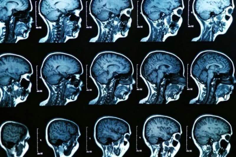 Ученые из Гонконга повысили эффективность лечения от Альцгеймера
