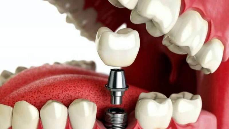 Что представляет собой имплантация зубов
