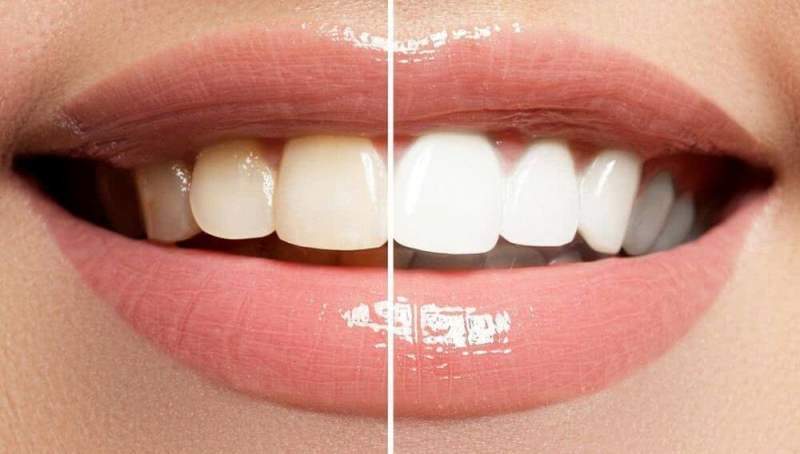 Пять самых популярных способов отбелить зубы
