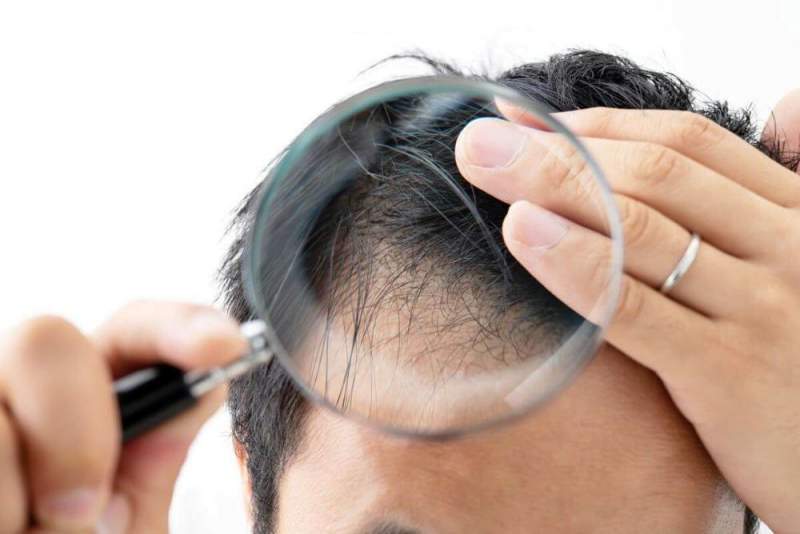Популярные методы пересадки волос и показания к их проведению