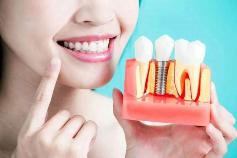 Зубные импланты и их разновидности
