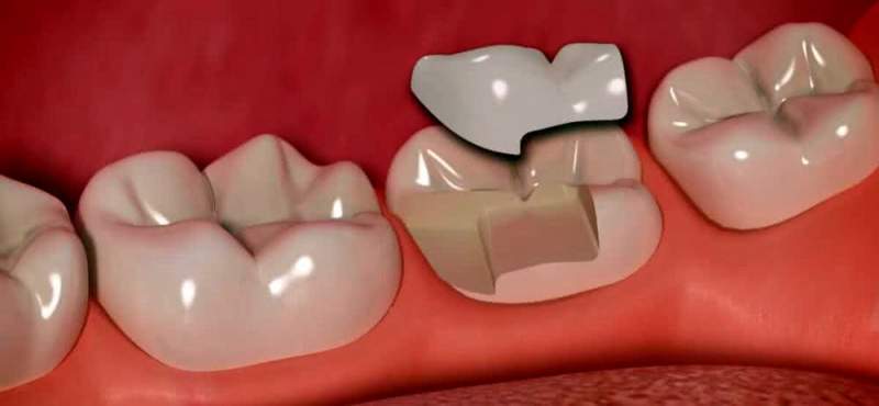 Керамическая восстановительная вкладка на зуб: виды, преимущества и показания к установке