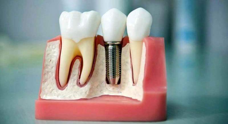Имплантация зубов: виды и особенности