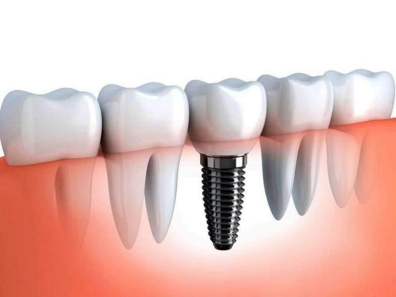Зубные импланты и их разновидности