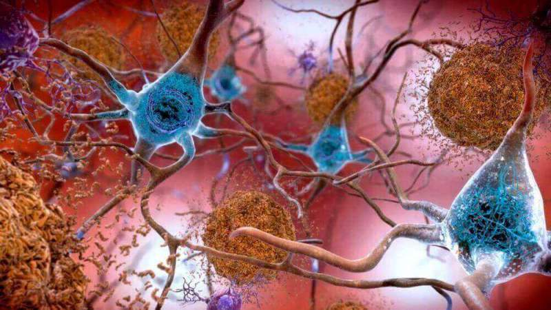 Стали известны новые факты о болезни Альцгеймера