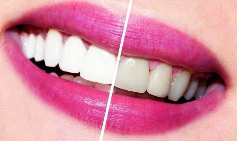 Современные методики реставрации зубов
