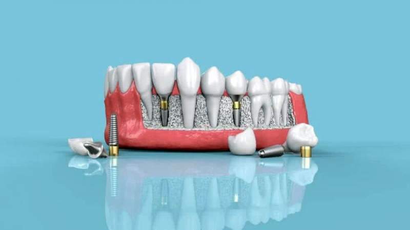 Нюансы установки зубных имплантов по инновационной технологии All-on-4