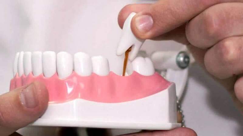 Плюсы протезирования зубов