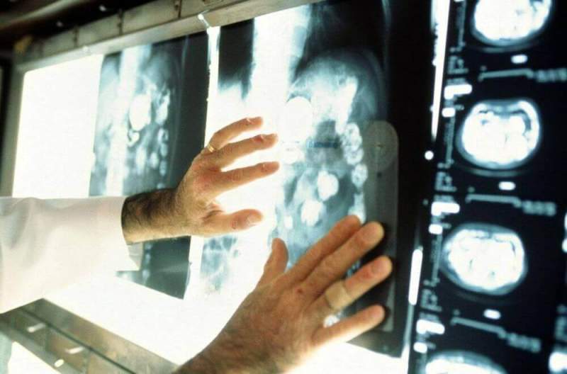 Медики: излишний оптимизм опасен для раковых больных