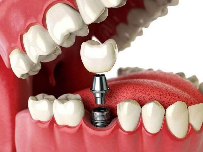 Нюансы установки зубных имплантов по инновационной технологии All-on-4
