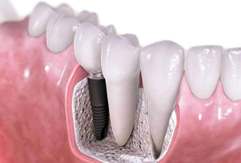 Особенности проведения имплантации зубов