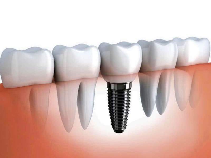 Советы по выбору стоматологической клиники и врача для проведения имплантации зубов