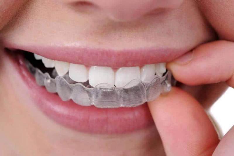 Исправление прикуса в современной стоматологии