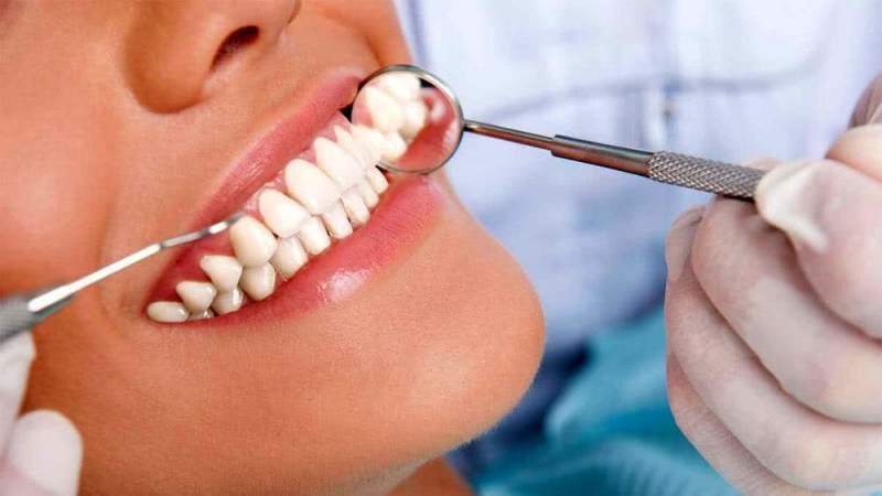 Керамическая восстановительная вкладка на зуб: виды, преимущества и показания к установке