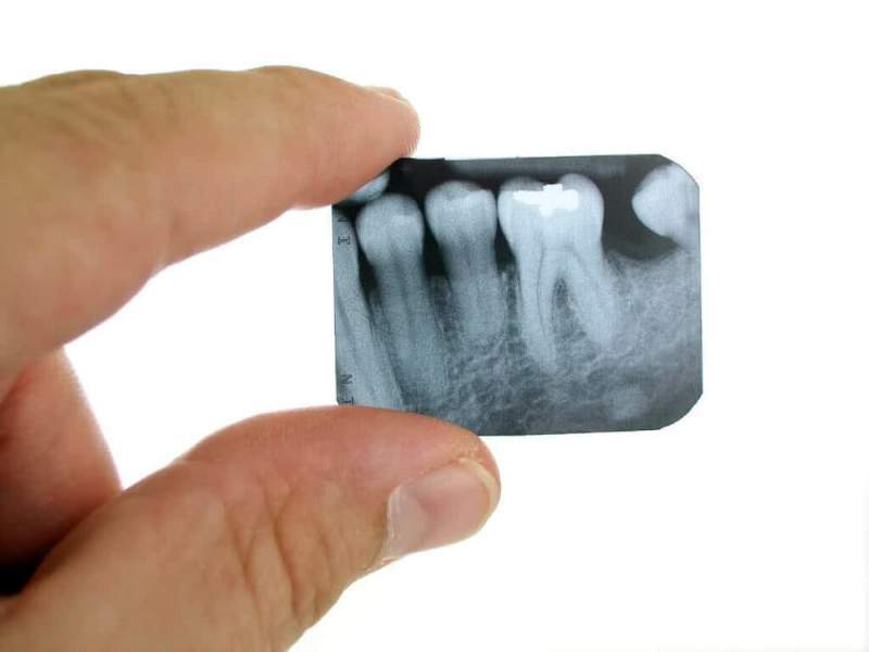 3D-рентген зубов