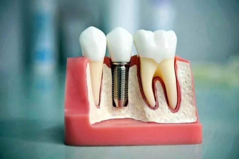 Преимущества зубных имплантатов