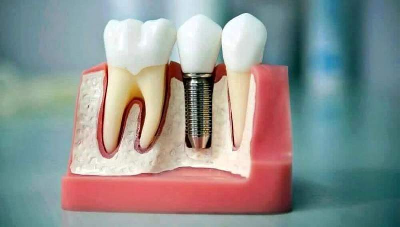 Имплантация зубов на верхней челюсти
