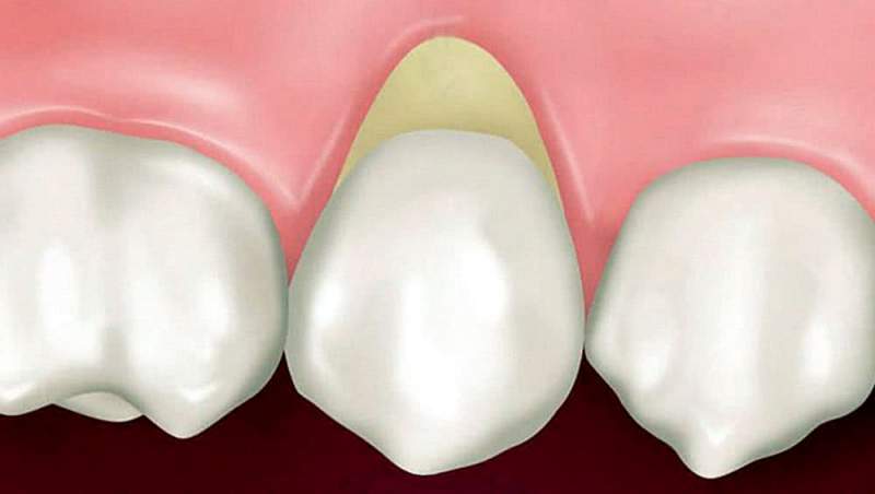 Лечение клиновидных дефектов зубов