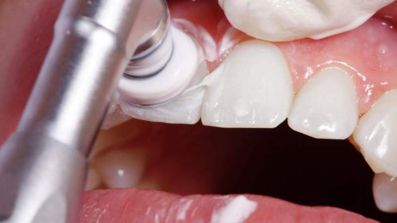 Процесс удаления зубного налета