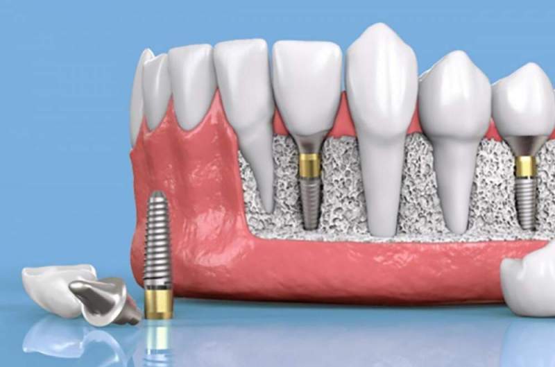 Как осуществляется имплантация зубов