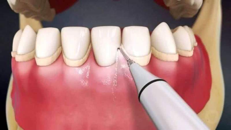 Подробнее о зубном камне: причины появления и методы лечения