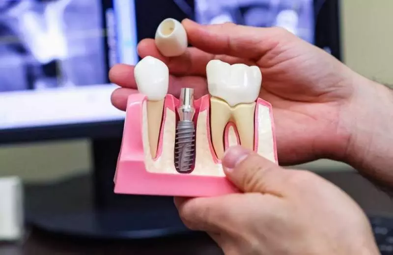 Как выбрать зубные импланты